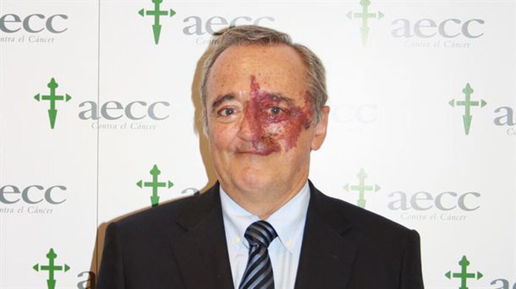 Terapi Kombinasi Tiga Obat Hapus Tumor Kanker Pankreas pada Model Tikus