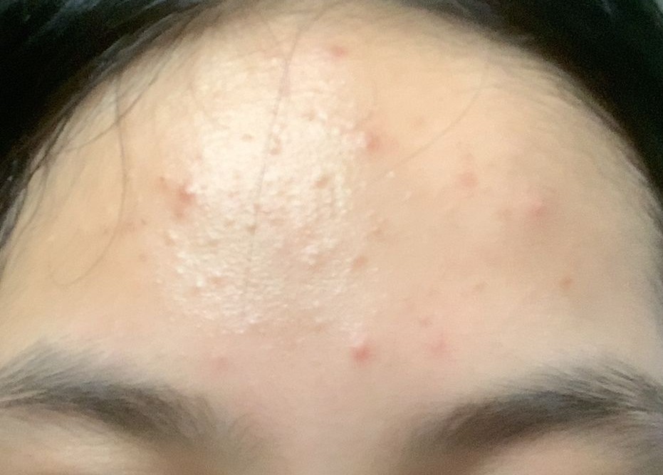 Bruntusan di Dahi: Penyebab dan Cara Mengatasi Secara Efektif